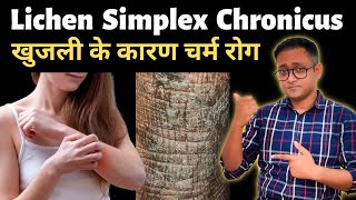 Lichen simplex chronicus  A very common skin problem  Hindi  Dr Supratim Saha [upl. by Atin337]