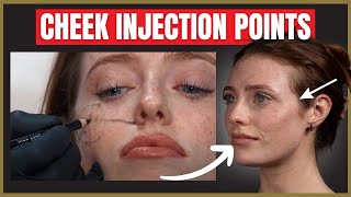 The Best Cheek Filler Injection Points  Where to inject the cheek for beautiful results [upl. by Ondrea]