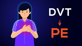 Overview of Acute Pulmonary Embolism in adults From DVT to PE [upl. by Naashar]