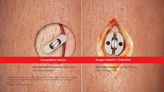 GRAVITY™ SYNCHFIX™ Syndesmosis Fixation Device Animation [upl. by Alphard]