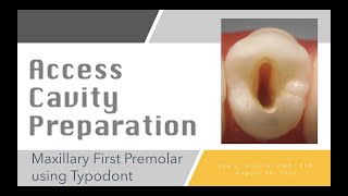 ACCESS CAVITY PREPARATION OF MAXILLARY FIRST PREMOLAR [upl. by Efthim]