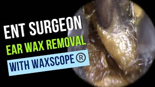 04  ENT Surgeon Ear Wax Removal [upl. by Borg287]