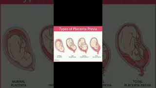 Types of placenta previa implantation  bleeding 🩸knowledge medical shortvideo share [upl. by Acimehs]