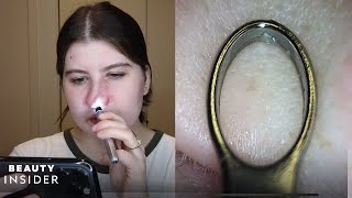 BlackheadRemoving Loop Has BuiltIn Microscope  The Zit Fix  Beauty Insider [upl. by Guyer59]