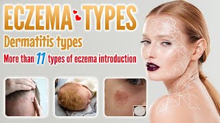 Eczema types with picture  More than 11 dermatitis eczema types you should know [upl. by Nnayllehs]