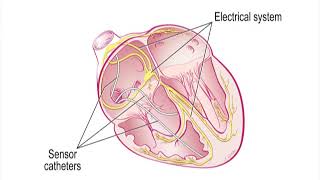 Preparing for the Cath Lab EP Study and Radiofrequency Ablation RFA  Heart Care Video Series [upl. by Ltsyrk]