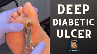 DEEP Diabetic Foot Ulcer podiatristfoot and ankle specialist treats a foot ulcer [upl. by Mathias685]