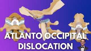 Atlanto Occipital Dislocation Causes Assessment and Treatment [upl. by Aioj]