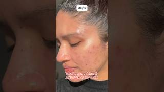 Dark spot serum for acne skin acnes skincare acneskin kbeauty koreanskincare acnescars [upl. by Alim648]