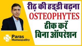 Spinal Osteophytes  रीढ़ की हड्डी बढ़ना  Spinal Bone SpursOsteophytes Treatment in Homeopathy Hindi [upl. by Avril258]