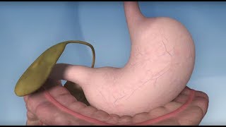 Gastric Bypass Complications  Mayo Clinic [upl. by Teews]