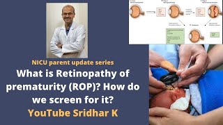 Retinopathy of prematurity in preterm babies Why do we screen for ROP how to treat Dr Sridhar K [upl. by Eeralih81]