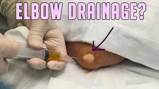 Aspiration Double Feature  Elbow and Wrist Drainage [upl. by Rani913]