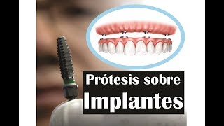 PROTESIS DENTALES SOBRE IMPLANTES  PRODENT [upl. by Novihc]