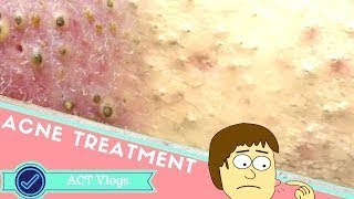 At Some Removal Blackheads On The Face Easy How To Remove Blackheads Easy [upl. by Kulda]