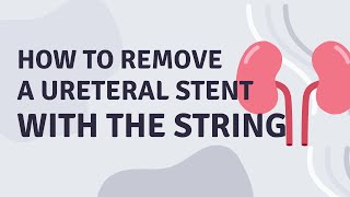 How to remove a ureteral stent on a string [upl. by Bainbridge]