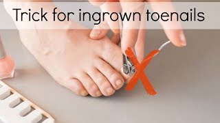 How to Fix Ingrown Toenails Easily [upl. by Euqinamod]