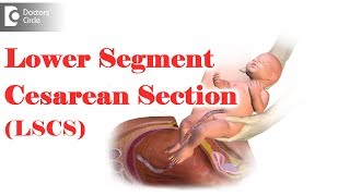 What is LSCS delivery Are you awake during an emergency C section  Dr Mini Salunkhe of C9 [upl. by Sarita268]