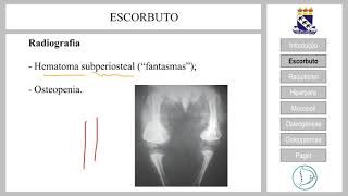 Doenças Genéticas e Osteometabólicas Parte I [upl. by Nahtonoj]