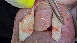 BIG UNHA ENCRAVADA  INGROWN TOENAIL nails podologia viral [upl. by Maren]