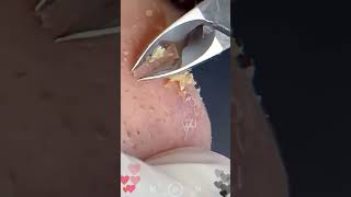 Skincare  Blackheads Removal 195 skincare skincare blackheads blackheads [upl. by Nylesoj]