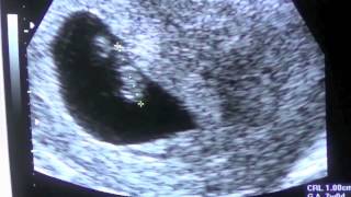 Pregnancy Vlog Week 7 First Ultrasound [upl. by Akinehc]