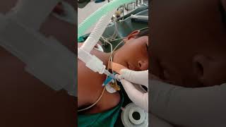 5 point auscultation for confirming position of endotracheal tube in trachea anaesthesia shorts [upl. by Xed]