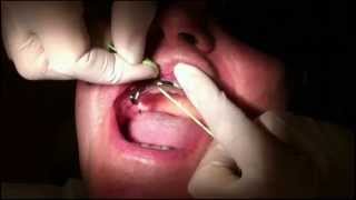 XFloss used on an upper implant bar [upl. by Nwavahs302]