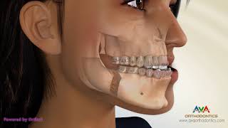 Surgical Orthodontic Treatment for Underbite or Crossbite  Transcortical Mandibular Setback [upl. by Oidiple]