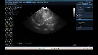 IQ 301 MEDIASTINAL LYMPHOID NODE ENLARGEMENT TFAST LUNG ECHOPAC ANALYSIS ULTRASOUND 3 [upl. by Oemac]