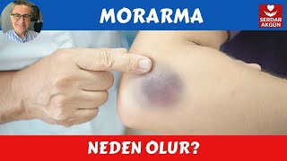 Morarma neden olur Sağlık Dr Serdar Akgün [upl. by Norrej308]