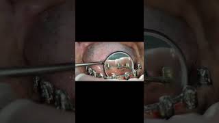 No gap between welded titanium wire and gumeffect of good alveoloplasty removing poor alveolar bone [upl. by Enitsahc]