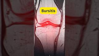 What is Bursitis drmuhammedziya humanbody discover anatomy bursitis knee shoulder [upl. by Ogeid]