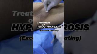 Treatment of Excessive Sweating skincareproductsbotox hyperhidrosis [upl. by Zollie]