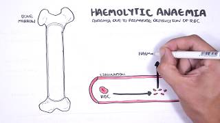 Haemolytic Anaemia  classification intravascular extravascular pathophysiology investigations [upl. by Valerie6]