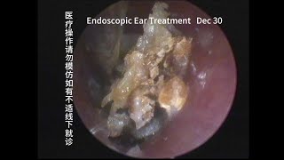 Cerumen mixed fungi similar to cholesteatoma 20231230 [upl. by Ahslek]