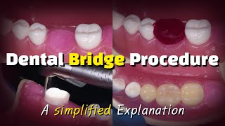 Dental Bridge Procedure [upl. by Llenrag88]