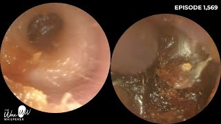 1569  Challenging ear wax removal in stenotic ear canal using both iCLEARscope amp WAXscope [upl. by Nadual]