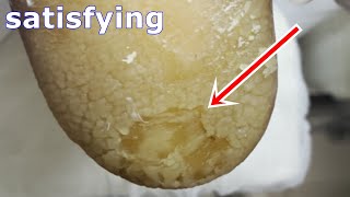 Cracked heels treatment amp Callus removal  Dead skin removal and Cracked heels treatment part 2 [upl. by Funk]