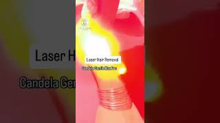 Laser hair removal with candela Gentle Max pro laser [upl. by Serena936]