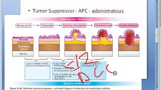 Pathology 521 h AdenoCarcinoma Colon sequence colorectal cancer tumor mutation DCC genetics [upl. by Cinemod215]