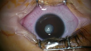 Microphthalmia cataract surgery with lens implant by Prof Amer Awan [upl. by Ynnol]