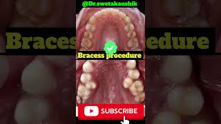 Crowded teeth shorts trendingshorts viralshorts Drswetakaushik 12th December shorts [upl. by Hortensa]