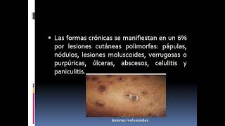 PRACTICA micosis sistémicas de inicio pulmonar [upl. by Cheatham]