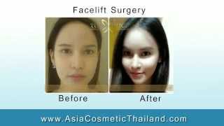 Before amp After Facelift in Bangkok Thailand  DrTanongsak [upl. by Rosdniw]