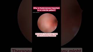 This is diagnostic and therapeutic hysteroscopy Viewers discretion is advised [upl. by Yelrehs]