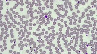 WBC Differential WBCPLT Estimate RBC Morphology [upl. by Puritan375]