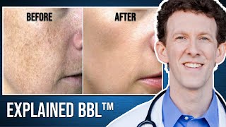 My BBL Laser Experience What You Need To Know BroadBand Light Photofacial [upl. by Tamer]