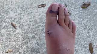 3  8 Days PostSurgery  Cheilectomy Surgery  Patient Recovery amp Review Hallux Rigidus Big Toe [upl. by Pepper]