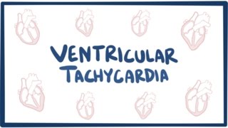 Ventricular tachycardia VT  causes symptoms diagnosis treatment amp pathology [upl. by Fulviah]